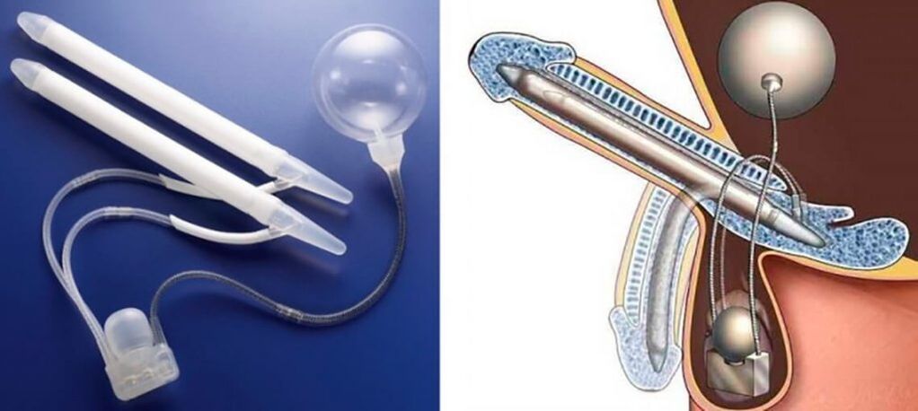 Penile prosthesis for penis enlargement